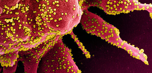 Colorized scanning electron micrograph of an apoptotic cell (red) heavily infected with SARS-COV-2 virus particles (yellow), isolated from a patient sample. Image captured at the NIAID Integrated Research Facility (IRF) in Fort Detrick, Maryland. Credit: NIAID - ALLOW IMAGES