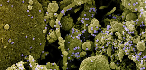 Colorized scanning electron micrograph of chronically infected and partially lysed cells (olive green) infected with a variant strain of SARS-CoV-2 virus particles (purple), isolated from a patient sample. Image captured at the NIAID Integrated Research Facility (IRF) in Fort Detrick, Maryland. Credit: NIAID - ALLOW IMAGES