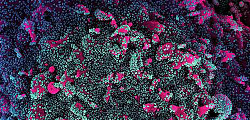 Coronavirus SARS-CoV-2 colorized scanning electron micrograph of a cell (pink) heavily infected with SARS-CoV-2 virus particles (teal and purple), isolated from a patient sample. Image courtesy of NIAID. - ALLOW IMAGES