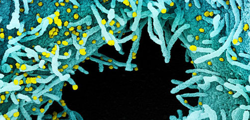 Colorized scanning electron micrograph of a cell heavily infected with SARS-CoV-2 virus particles (yellow), isolated from a patient sample. The black area in the image is extracellular space between the cells. Image captured at the NIAID Integrated Research Facility (IRF) in Fort Detrick, Maryland. NIAID - ALLOW IMAGES
