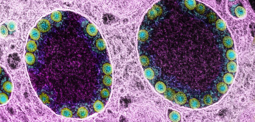 Transmission electron micrograph of SARS-CoV-2 virus particles (green) within endosomes of a heavily infected nasal Olfactory Epithelial Cell. Image captured at the NIAID Integrated Research Facility (IRF) in Fort Detrick, Maryland. Credit: NIAID - ALLOW IMAGES