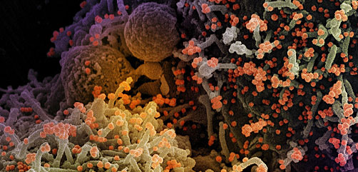 Scanning electron micrograph of a cell infected with a variant strain of SARS-CoV-2 virus particles (orange), isolated from a patient sample and colorized. Image captured at the NIAID Integrated Research Facility (IRF) in Fort Detrick, Maryland. - ALLOW IMAGES