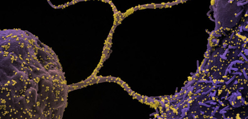Colorized scanning electron micrograph of CCL-81 cells (purple) infected with SARS-CoV-2 virus particles (yellow), isolated from a patient sample. The tentacle-like protrusions from the cells are filapodia, which extend from infected cells, attach to neighboring cells, and promote viral infection as a transport system for virus particles. Image captured at the NIAID Integrated Research Facility (IRF) in Fort Detrick, Maryland. Credit: NIAID - ALLOW IMAGES