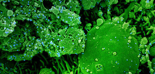 Colorized scanning electron micrograph of chronically infected and partially lysed cells (green) infected with a variant strain of SARS-CoV-2 virus particles (blue), isolated from a patient sample. Image captured at the NIAID Integrated Research Facility (IRF) in Fort Detrick, Maryland. Credit: NIAID - ALLOW IMAGES