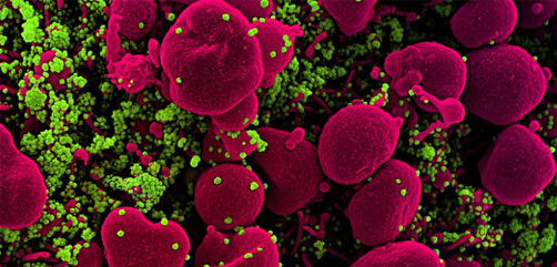 Colorized scanning electron micrograph of an apoptotic cell (pink) heavily infected with SARS-CoV-2 virus particles (green), isolated from a patient sample. Image captured at the NIAID Integrated Research Facility (IRF) in Fort Detrick, Maryland. Credit: NIAID - ALLOW IMAGES