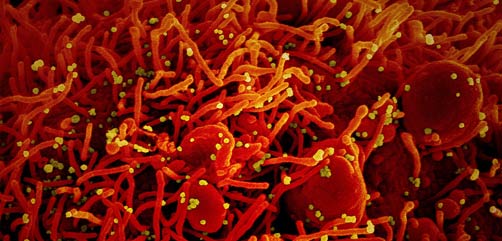 Colorized scanning electron micrograph of an apoptotic cell (red) infected with SARS-COV-2 virus particles (yellow), isolated from a patient sample. Image captured at the NIAID Integrated Research Facility (IRF) in Fort Detrick, Maryland. - ALLOW IMAGES