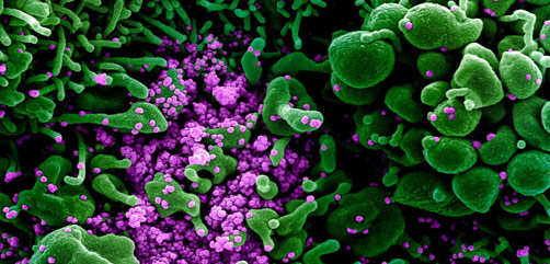 Colorized scanning electron micrograph of an apoptotic cell (green) heavily infected with SARS-COV-2 virus particles (purple), isolated from a patient sample. Image captured and color-enhanced at the NIAID Integrated Research Facility (IRF) in Fort Detrick, Maryland. Credit: NIAID - ALLOW IMAGES