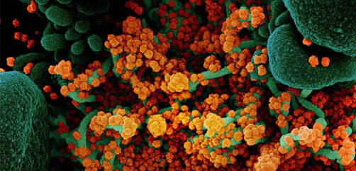 Colorized scanning electron micrograph of an apoptotic cell (green) heavily infected with SARS-CoV-2 virus particles (orange), isolated from a patient sample. Image at the NIAID Integrated Research Facility (IRF) in Fort Detrick, Maryland. Credit: NIAID - ALLOW IMAGES