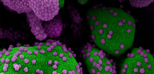 Colorized scanning electron micrograph of an apoptotic cell (green) heavily infected with SARS-CoV-2 virus particles purple), isolated from a patient sample. Image captured at the NIAID Integrated Research Facility (IRF) in Fort Detrick, Maryland. - ALLOW IMAGES