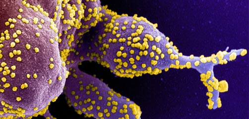 Colorized scanning electron micrograph of an apoptotic cell (purple) heavily infected with SARS-COV-2 virus particles (yellow), isolated from a patient sample. Image captured at the NIAID Integrated Research Facility (IRF) in Fort Detrick, Maryland. - ALLOW IMAGES
