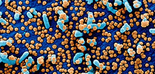 Colorized scanning electron micrograph of a VERO E6 cell (blue) heavily infected with SARS-COV-2 virus particles (orange), isolated from a patient sample. Image captured and color-enhanced at the NIAID Integrated Research Facility (IRF) in Fort Detrick, Maryland. - ALLOW IMAGES