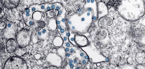 Transmission electron microscopic image of an isolate from the first U.S. case of COVID-19, formerly known as 2019-nCoV. The spherical viral particles, colorized blue, contain cross-sections through the viral genome, seen as black dots. - ALLOW IMAGES